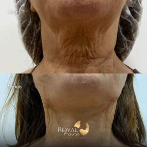 Rugas - Bioestimulador Royal Face