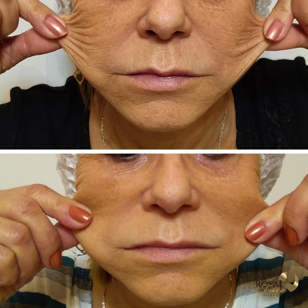 Bioestimulador de Colágeno Antes e Depois